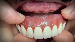 Finalizing a Highly Esthetic Denture with Dentist amp Patient InLab [upl. by Atirys781]