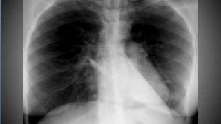 Chest xray Pneumomediastinum [upl. by Dnarud]