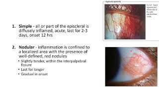 EPISCLERITIS AND SCLERITIS [upl. by Ellenij]