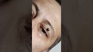 Botfly Maggot Removal spa doctor satisfying pimple removal [upl. by Earle169]