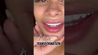 PerfectSmile PorcelainVeneers FlawlessTeeth MIAMI dentaldesign dental [upl. by Elsi]