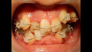 歯列矯正 歯科 トータル治療費 631800円 でこぼこ前歯の美容矯正！！ [upl. by Nolana339]