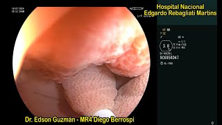 Underwater endoscopic mucosal resection UEMR of a colonic large pedunculated polyp [upl. by Nale]