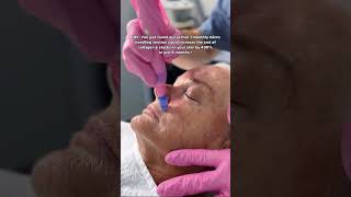 Why Microneedling ytshorts shortvideos microneedling microneedlingbenefits [upl. by Aufa]