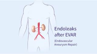 Endoleaks after Endovascular Repair of Thoracic Aortic Aneurysms EVAR [upl. by Ennoid393]