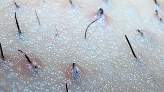 JUICY SATISFYING INGROWN HAIR PULL😍😍😍 [upl. by Guenna170]