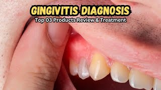 🦷 Gingivitis Diagnosis amp Best Treatment Products Say Goodbye to Gum Disease 🌟 [upl. by Lanae]