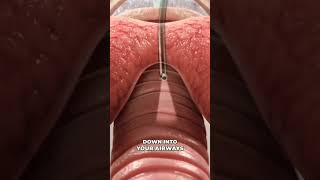 medicalanimation bronchoscopy [upl. by Narruc]