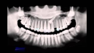 Treatment of impacted canine [upl. by Essined261]