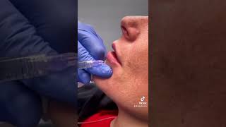 Lip Fillers by Dermatologist in New Jersey lipfiller dermatology dermatologist [upl. by Durante]