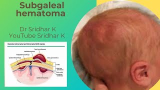 Subgaleal hematoma in babies Serious conditionnot to miss Dr Sridhar Kalyanasundaram [upl. by Plate]