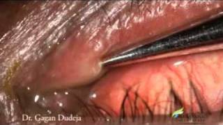 Mini Monoka Stent for Punctal Stenosis [upl. by Ahsiela414]