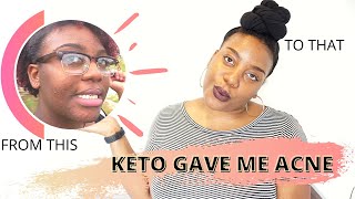 HOW THE KETO DIET DESTROYED MY SKIN  3 ways I cleared my acne for good [upl. by Nork]