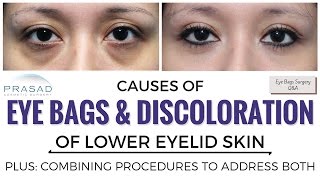 The Causes of Eye Bags and Discolored Lower Eyelid Skin and Treating Both Separately [upl. by Corry]