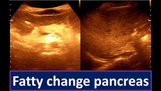 Moderately diffuse fatty infiltration of the Liver  Fatty change pancreas [upl. by Nordine975]