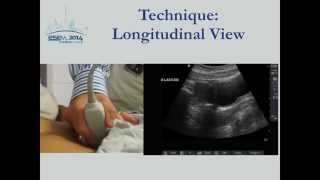 First Trimester Pregnancy Ultrasound [upl. by Anila]