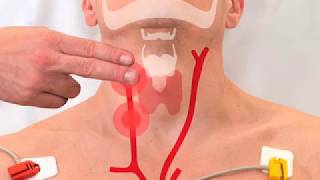 Carotid Sinus Massage 2017 [upl. by Rorie752]