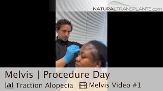 Hair Transplant Procedure Day Female Hair Loss  Dr Blumenthal Melvis [upl. by Haleigh]