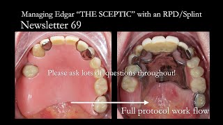 Study Club 5 Managing Edgar the Sceptic with a Scandinavian removable partial denture Finlay Sutton [upl. by Tavy]