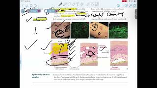 PEMPHIGUS VULGARISBULLOUS PEMPHIGOID [upl. by Daus]