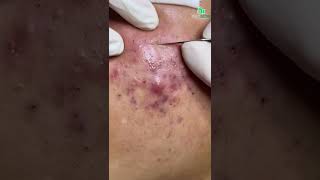 Inflamed Acne and Blackhead Removal CloseUp Secrets to Clear and Smooth Skin [upl. by Burleigh]