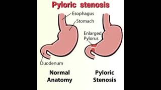 Pyloric stenosis Fluid calculation mrcpch Recall Communication [upl. by Kasper63]