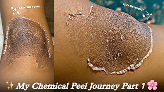 My TCA 25 Chemical Peel Journey Pt1 Chemical Peel on knees  TCA chemical peel result sristydutta [upl. by Justine]