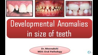 Developmental disturbances in Size of teeth [upl. by Nnyltak]