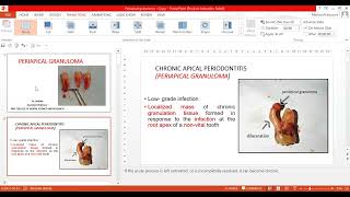 Periapical Granuloma [upl. by Nilauqcaj]