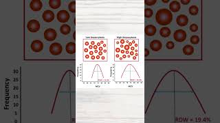 RDW in iron deficiency anaemia  MRCP revision  shorts irondeficiencyanemia redbloodcells [upl. by Adnocahs]