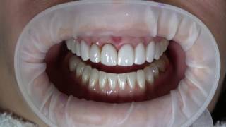 eMax Veneer Removal with Hard Tissue Laser [upl. by Guss]