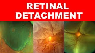 Retinal Detachment Types Risk Factors Pathophysiology Symptoms and Signs [upl. by Yretsym]