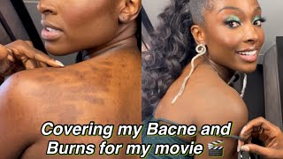 How I Cover My Bacne and Burns While I Film Movies 🎬 [upl. by Katonah]