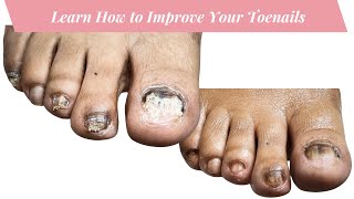 How to Nail Fungus Toenail Recovery 3rd Visit [upl. by Monto958]