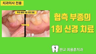 치수 괴사 협측 부종 치아의 1회 신경 치료 판교최용훈치과 치아살리기 플라젠신경치료 [upl. by Marozas]