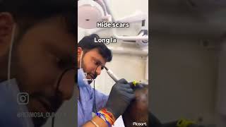 micropigmentation scalp noninvasive treatment hair hairrestoration haircaretips skincare [upl. by Granlund121]