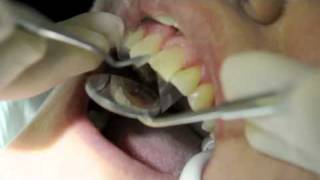 Teeth Bonding  Teeth Bonding Procedure [upl. by Cranston]