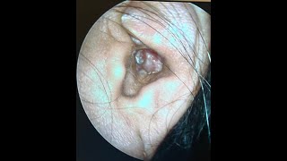 Super Enlarged Ear Canal  What is that [upl. by Lauritz]