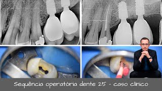 Tratamento Endodôntico  Caso clínico completo  Dente 25 Endodontia Microscópica Avançada [upl. by Amak541]