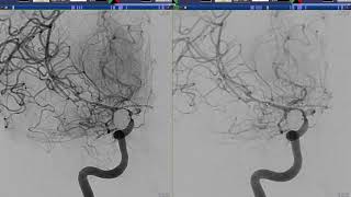 Intraarterial Treatment of Intracranial Vasospasm Nimodipine [upl. by Enelam18]