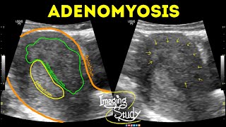 Adenomyosis  Ultrasound  Case 42 [upl. by Atiuqahc]