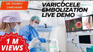 Live Varicocele Embolization Case 1 Nonsurgical treatment of Varicocele  Dr Gaurav Gangwani [upl. by Lyram]