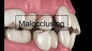 Malocclusion [upl. by Ydnem]