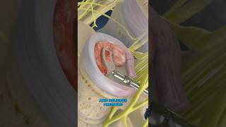 TLIF surgery for degenerative disc disease 3D Animation [upl. by Clynes]