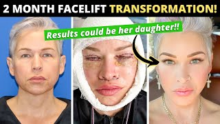 49 Year Old Turns Back the Clock 10 Years with Facelift and Lip Lift Two Month Facelift Journey [upl. by Salangia895]