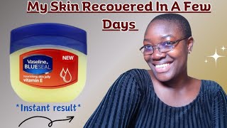 How I Got Rid Of Eczema Fast With Vaseline Blue seal Petroleum Jelly ✅ vaselineindia [upl. by Ahseyd]