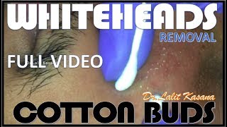 WHITEHEADS REMOVAL WITH COTTON BUDS FULL VIDEO [upl. by Darahs803]