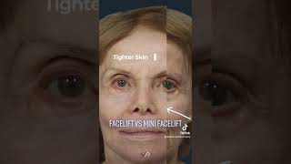 Facelift vs Mini Facelift Understanding the Difference  Dr David Stoker [upl. by Nazler]