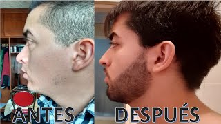 ¿Cómo tener barba siendo lampiño  Increíbles resultados de minoxidil barba [upl. by Ahsele]