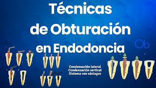 Técnicas de Obturación en Endodoncia 🦷 [upl. by Asela]